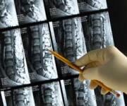 osteoporosis-facts